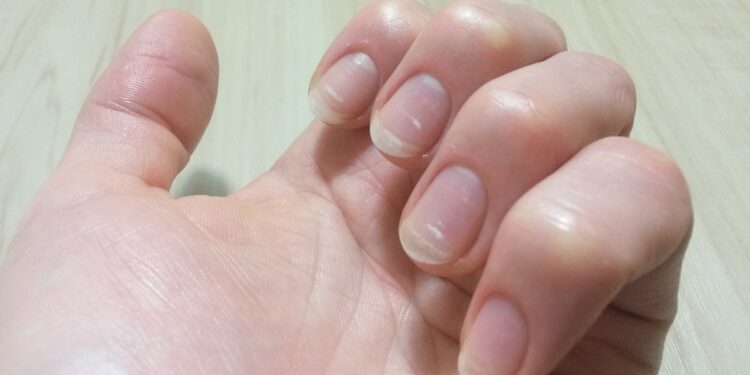 Causes of White Spots on Nail Plates 14 Nails & Beauty Magazine Hubs