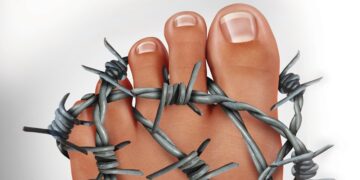 Manage Calluses and Ingrown Nails Efficiently 1 Nails & Beauty Magazine Hubs